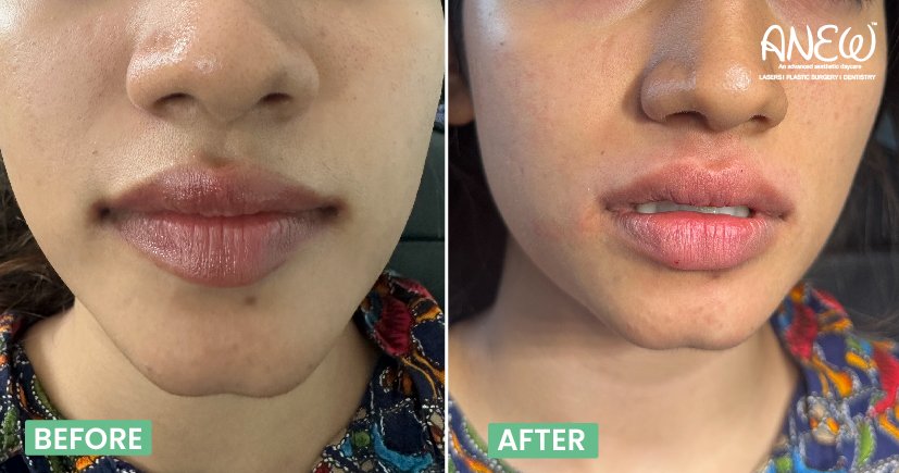Dermal filler in banashankari bangalore